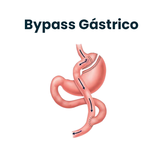 Bypass Gástrico en Y de Roux : Dr. Omar Fonseca