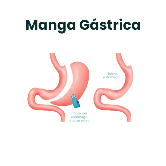 Manga gástrica : Dr. Omar Fonseca